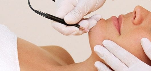 electrolysis-hair-removal-image Image of a woman having electrolysis hair removal