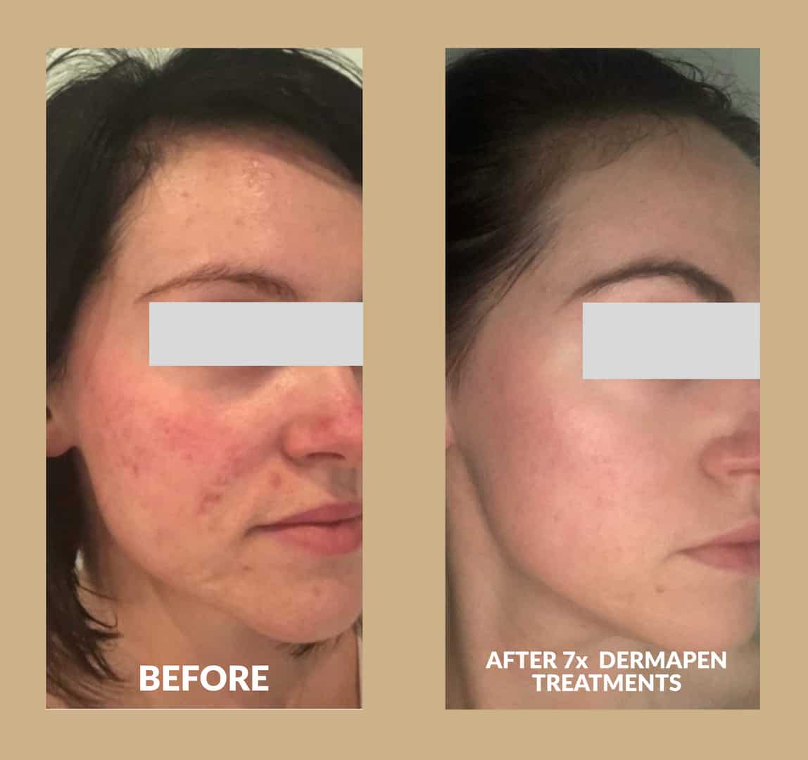 Two images showing before and after dermapen microneedling treatments