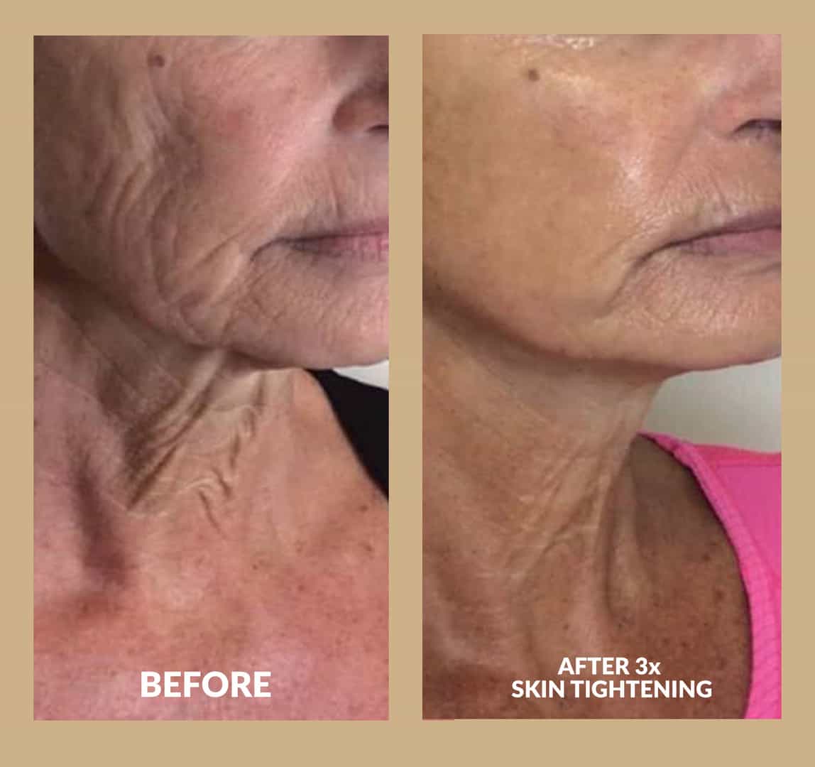 Two images of before and after neck skin tightening treatments