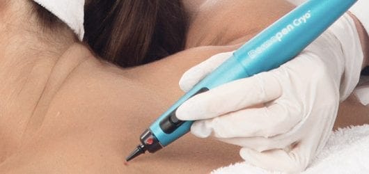 dermapen-cryo-square Image of a woman having a mole removed with the Cryopen
