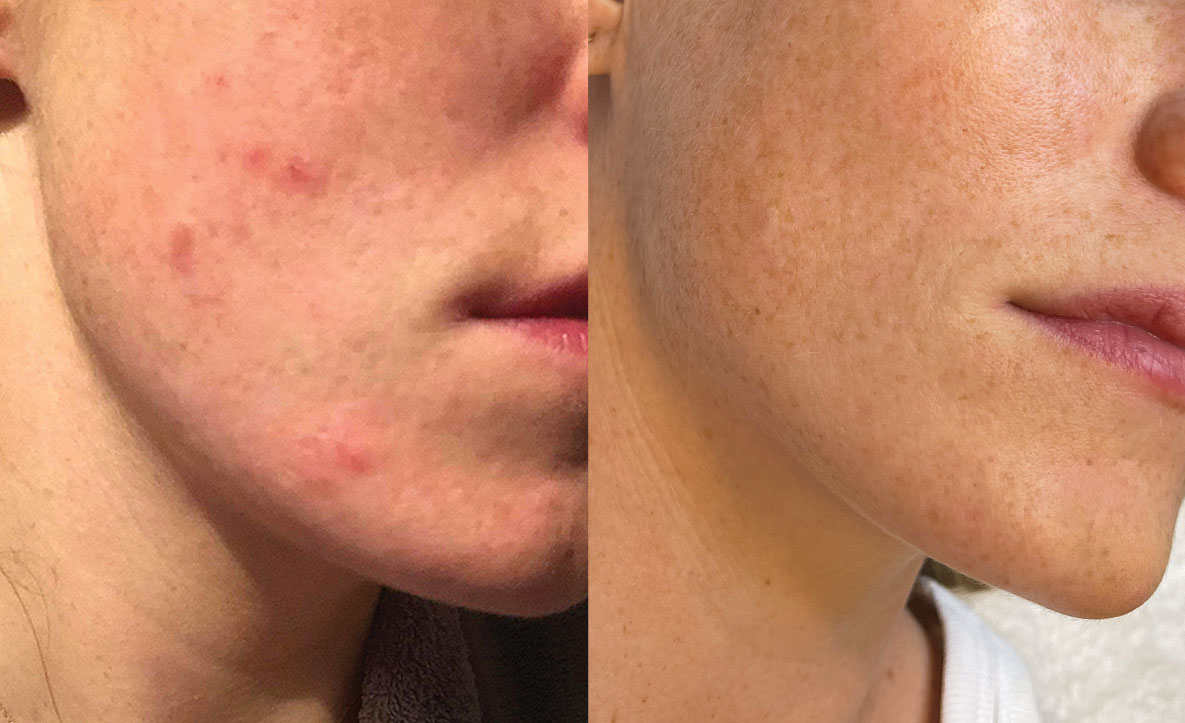 Amazing results from Dermapen microneedling