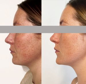 Dermapen results before and after