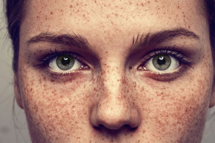 Woman with hyperpigmentation