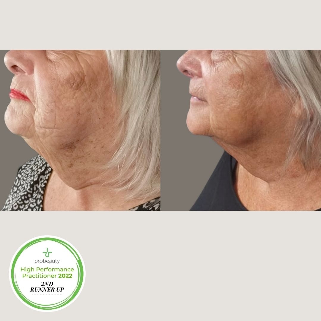 Congratulations to the 2022 Probeauty High-Performance Practitioner - 2nd Runner Up, Bernice Olderwagen!⁠
⁠
Bernice helped this lovely client treat: Pigmentation, Tightening of Neck, Jawline and Jawls.⁠
⁠
Her treatments were:⁠
3 x IPL Treatments⁠
7 x Skin Tightening Treatments⁠
⁠
Her Homecare: Personalised DP Dermaceuticals and O Cosmedics Regime.⁠
⁠
Discover our Skin Memberships and how we can help you achieve #skinconfidence via our Linkin.bio