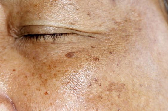 woman with age spots, pigmentation