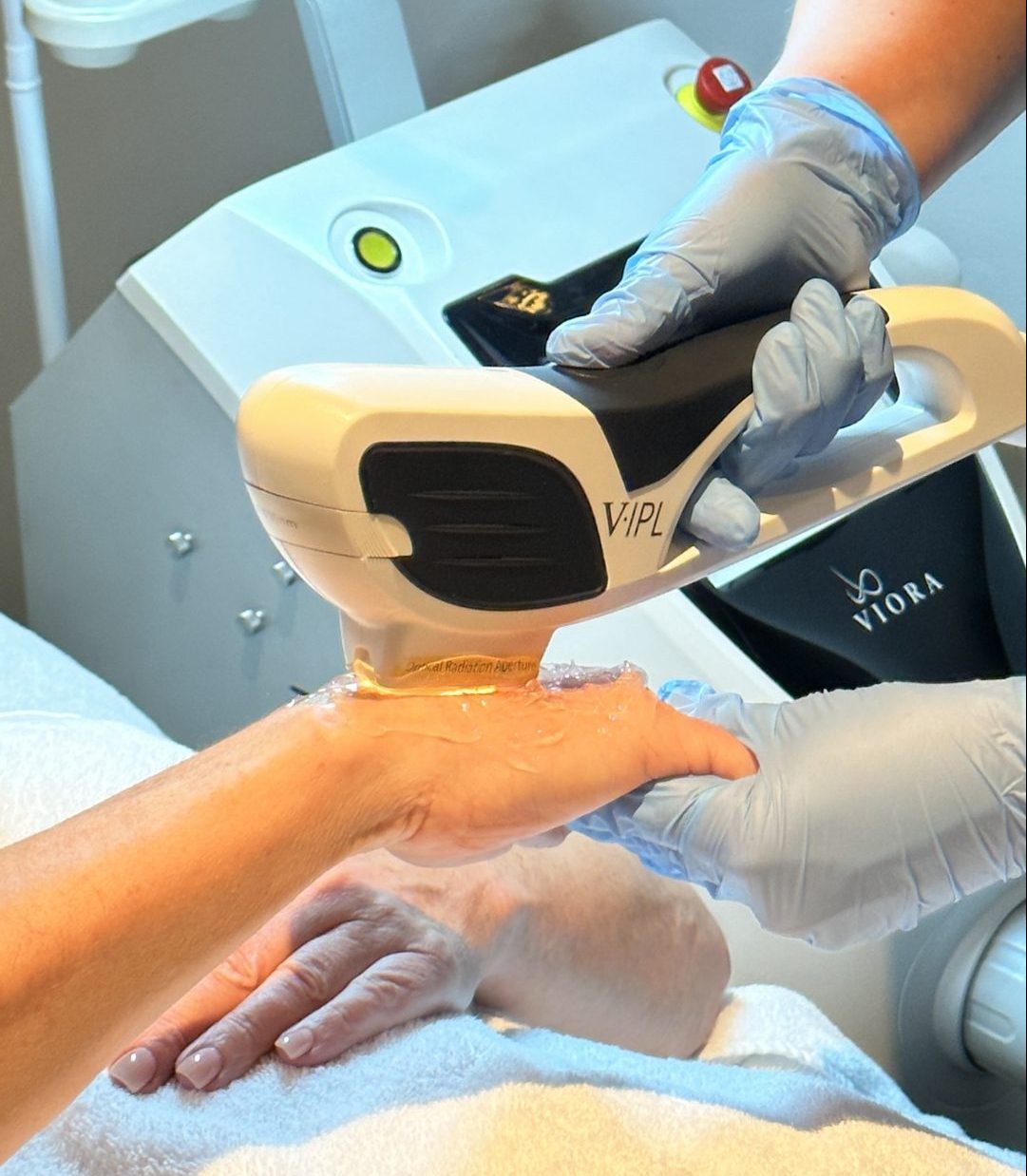 woman getting IPL treatment on her hand to treat sunspots at Nicola Quinn