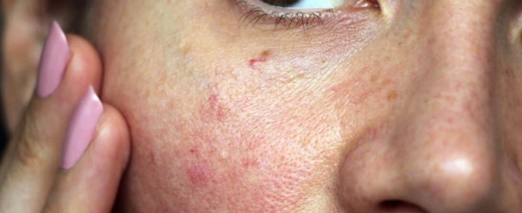 Broken Capillaries Red Nose Veins Ipl Can Help Nicola Quinn Spa