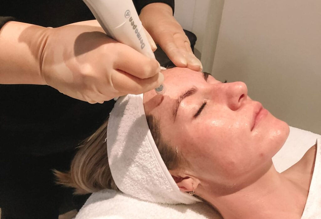 dermapen-in-action-microneedling dermapen-in-action-microneedling