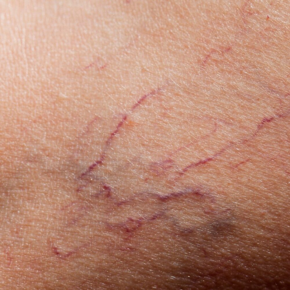 thread-veins-1-1500x1061